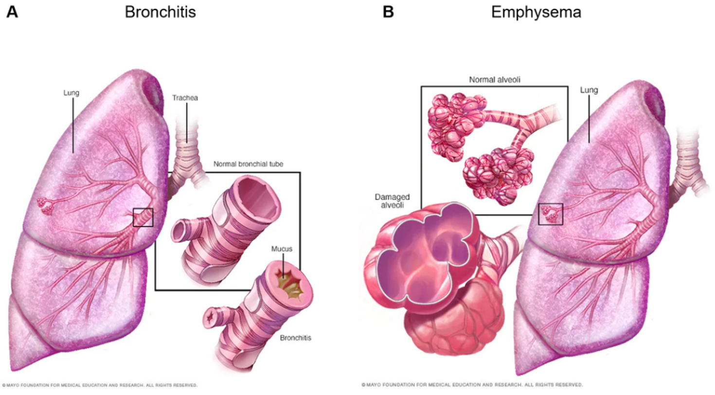 Lung Changes in Patients with COPD (Adapted from Mayo Clinic, 2023)