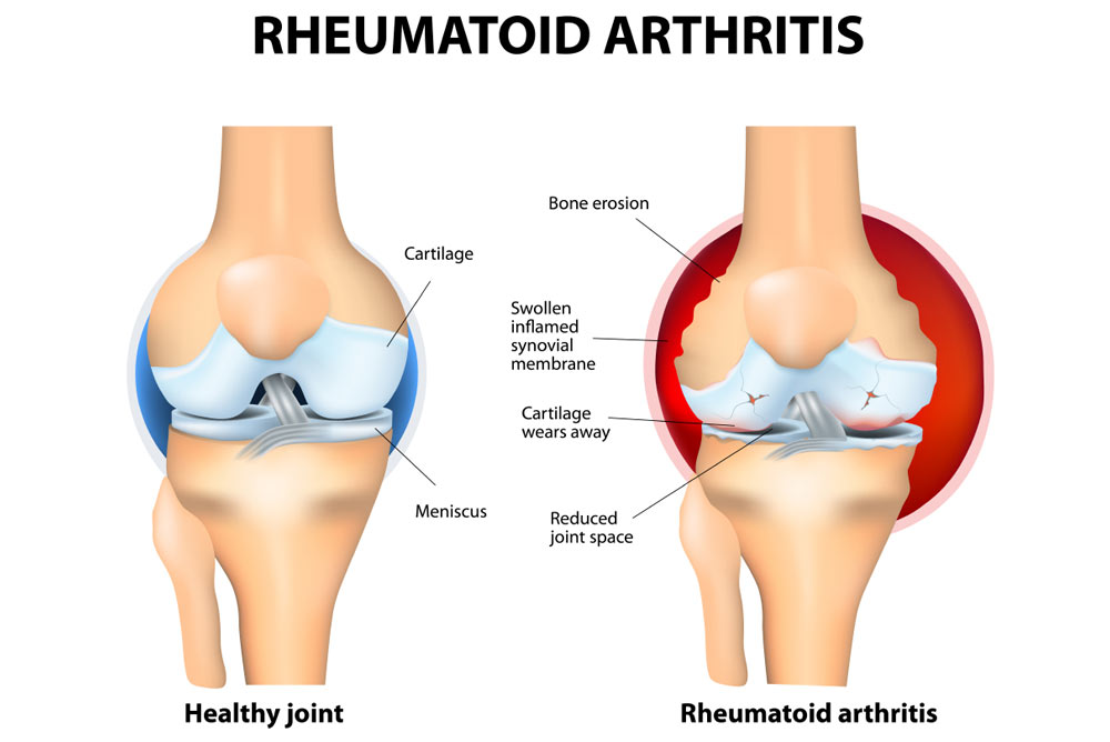 Healthy vs RA joint