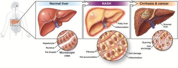 Fat-Induced Liver Inflammation Drives NASH Progression