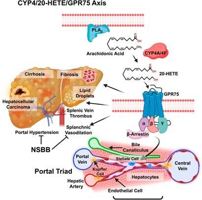 Activation of GPR75 leading to progression of liver disease