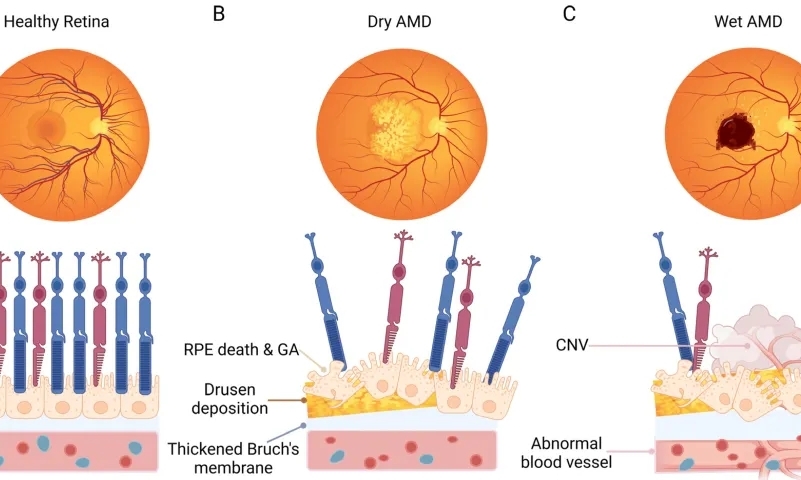 老年黄斑变性AMD治疗药物迎来长效时代？