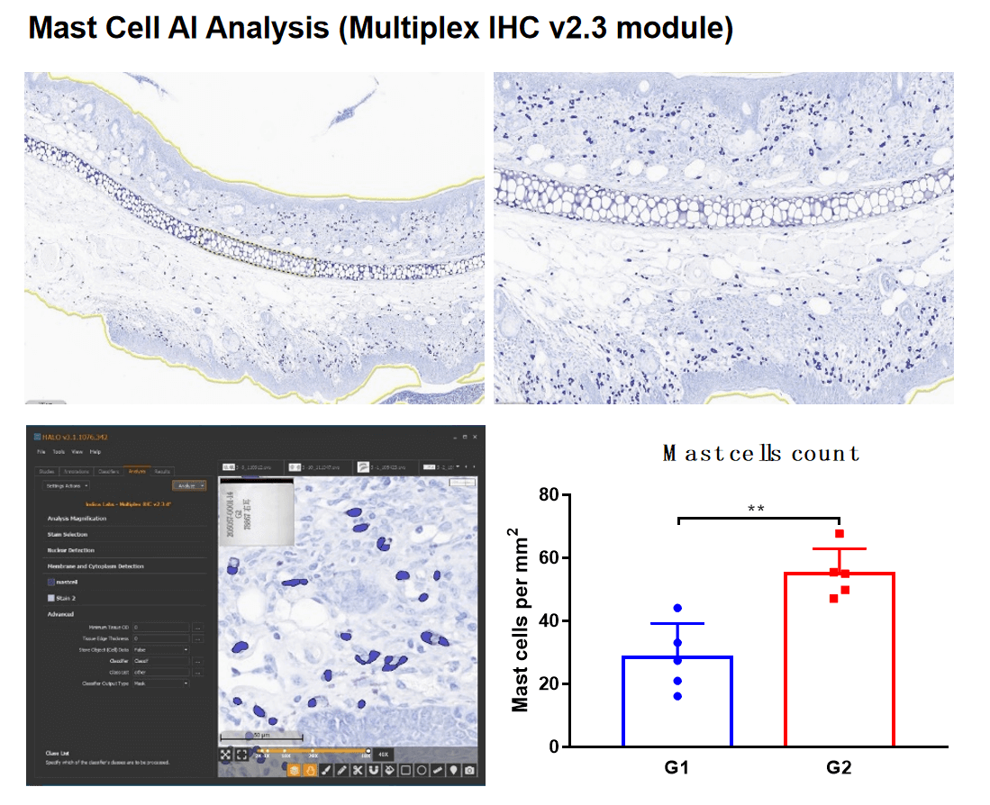 HE staining- inflammation in psoriasis skin tissue