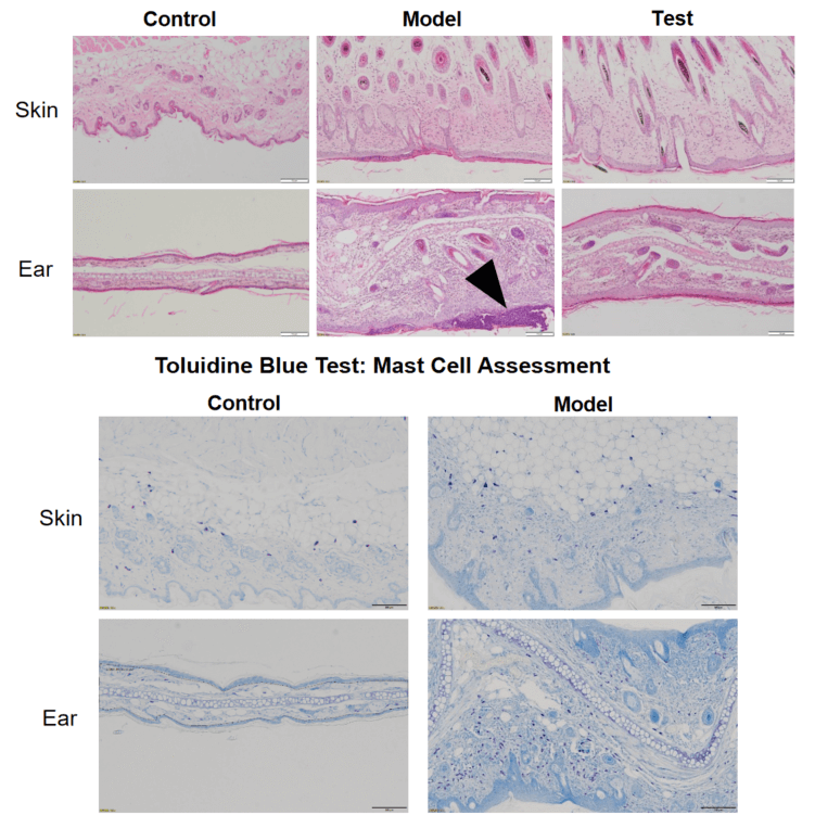 HE staining- inflammation in atopic dermatitis skin tissue